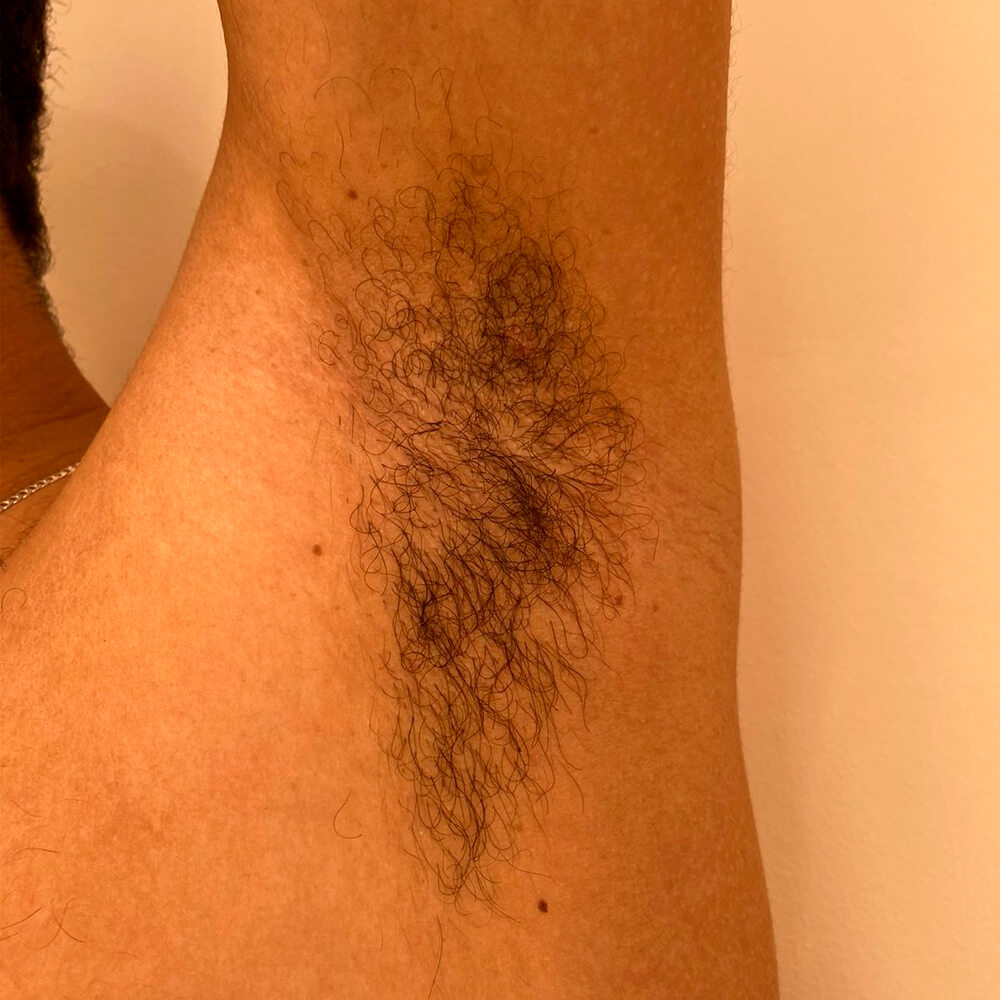 Depilação LED Axila Homem