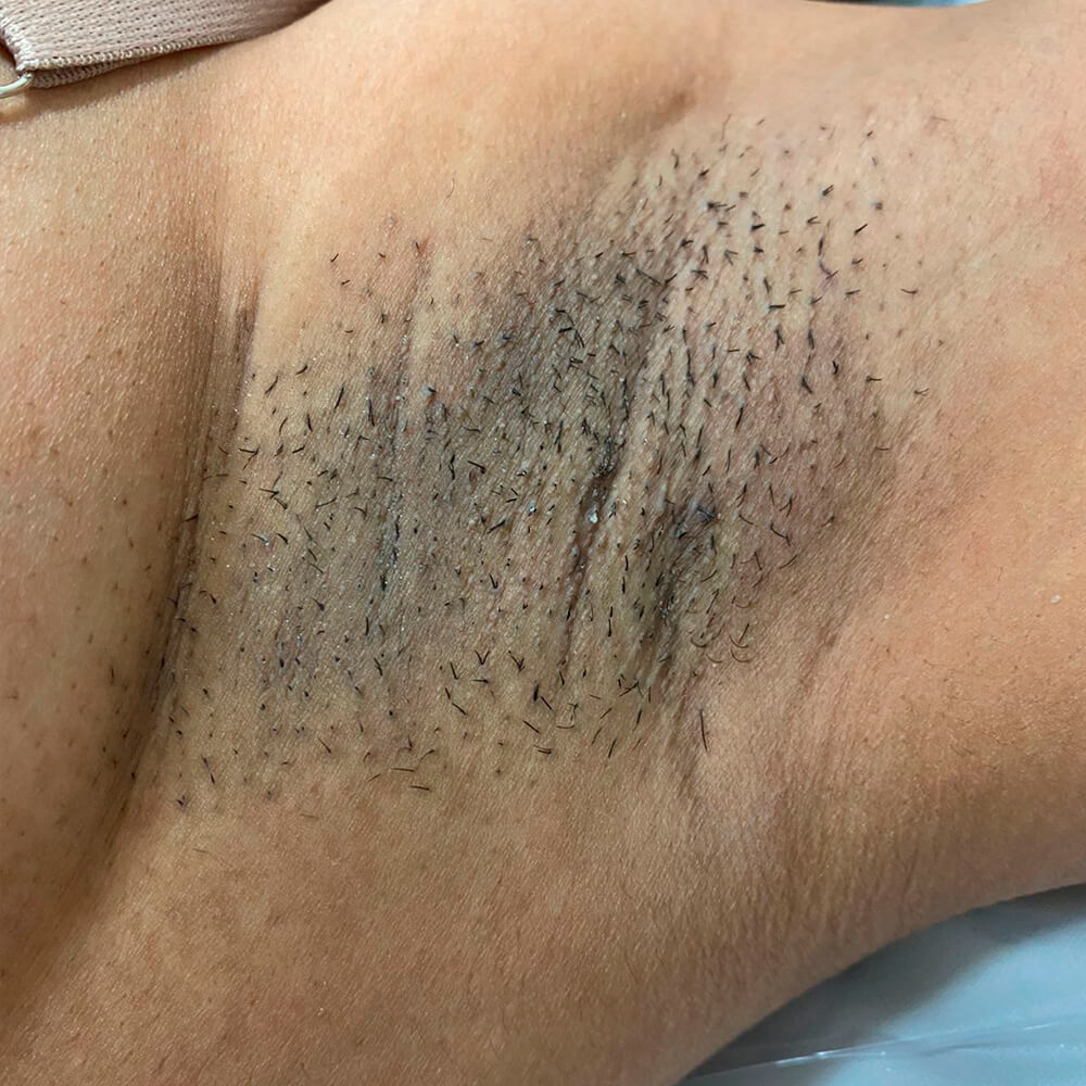 Depilação LED Axila Mulher