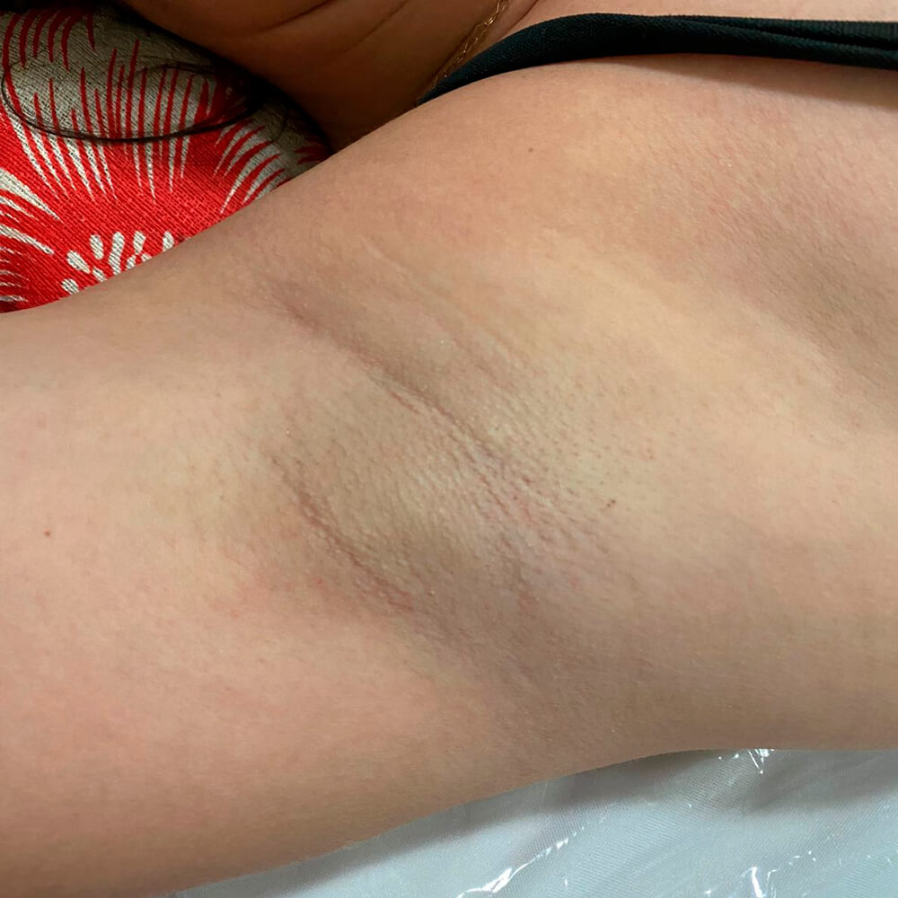 Depilação LED Axila Mulher