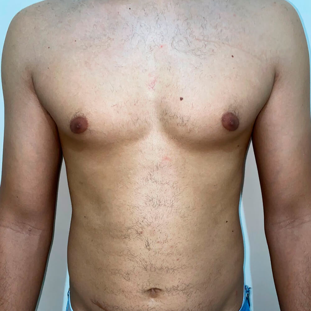 Depilação LED abdome Homem